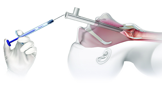 Operating Room Trans-Oral Injections